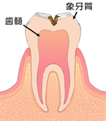 歯の中（象牙質）のむし歯